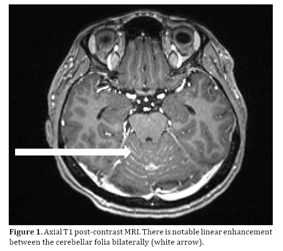 pancreas-cerebellar-folia-bilaterally