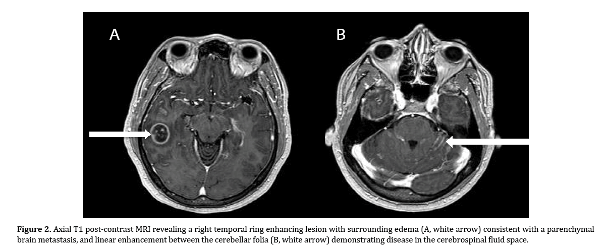 pancreas-cerebrospinal-fluid-space