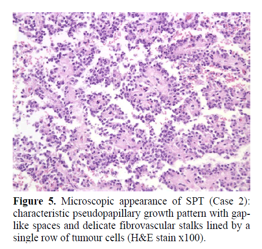 pancreas-characteristic-pseudopapillary-growth