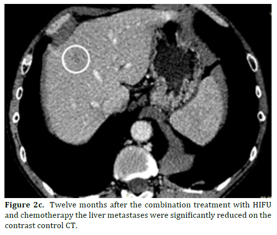 pancreas-chemotherapy-liver-metastases