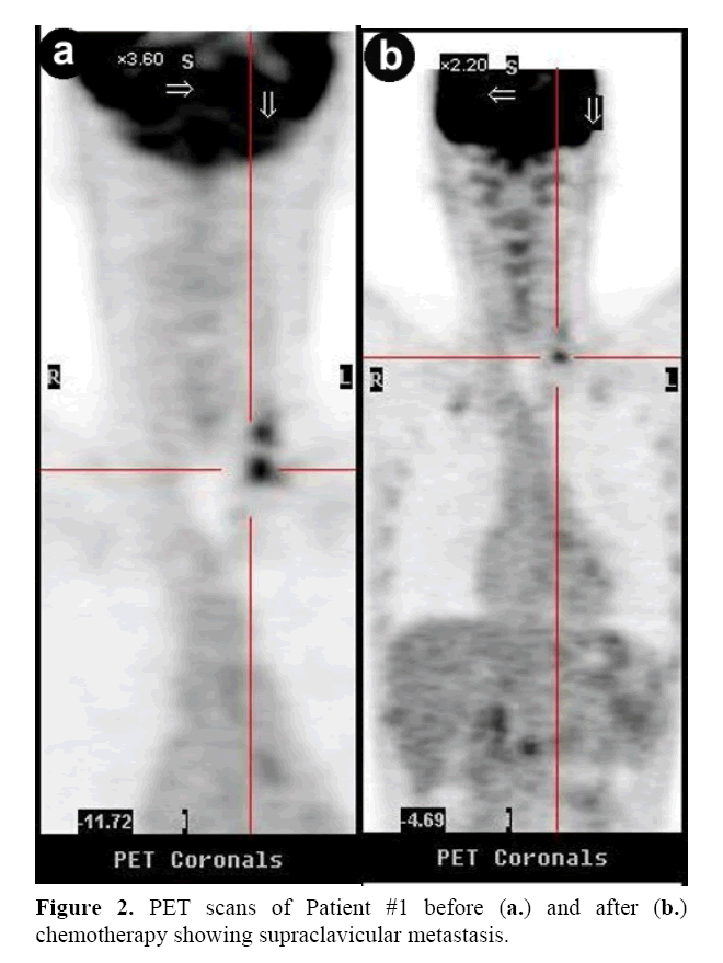 pancreas-chemotherapy-showing