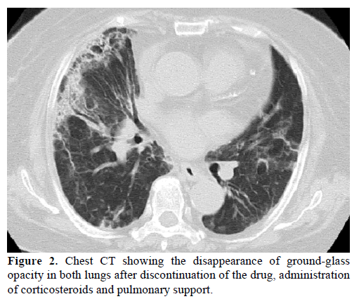 pancreas-chest-ct-ground-glass