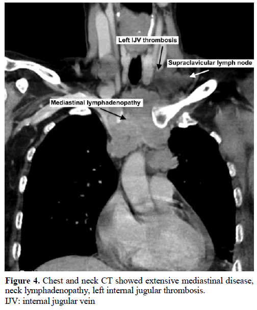 pancreas-chest-mediastinal-disease