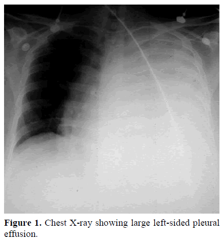 pancreas-chest-x-ray-pleural-effusion