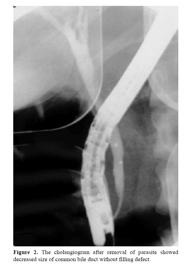 pancreas-cholangiogram-after-removal