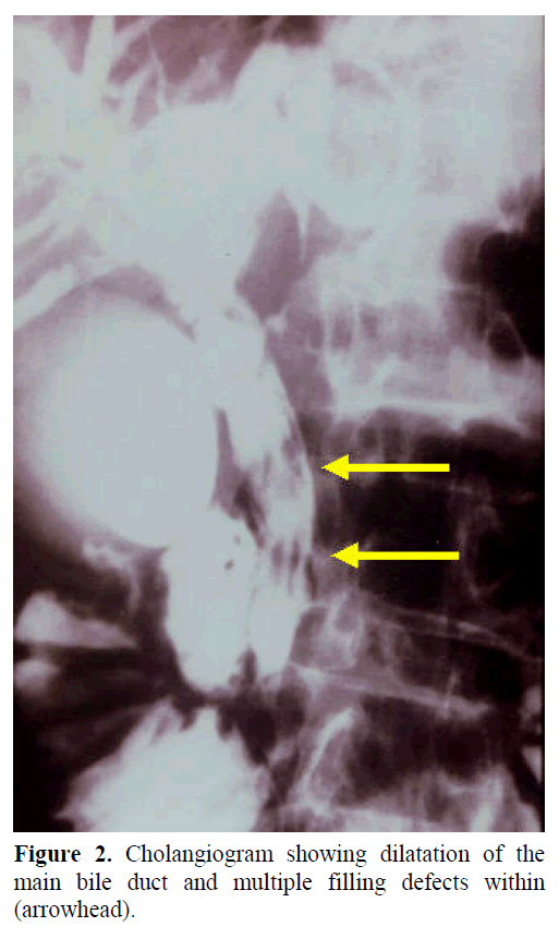 pancreas-cholangiogram-dilatation-duct