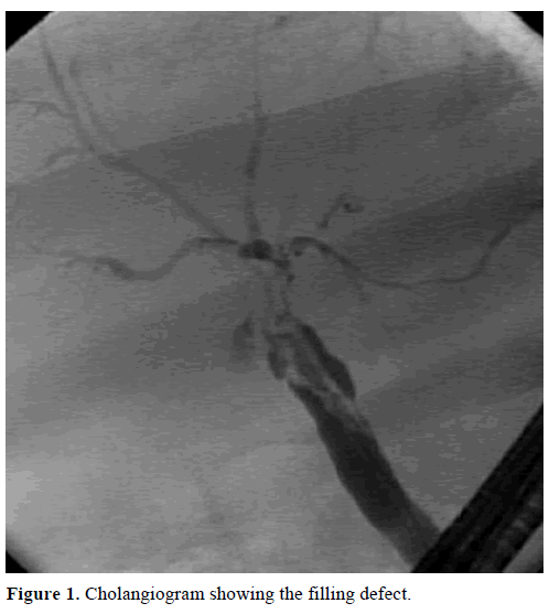 pancreas-cholangiogram-filling-defect