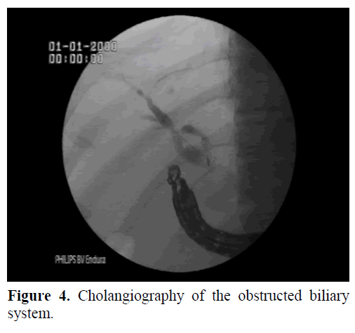 pancreas-cholangiography-obstructed-biliary