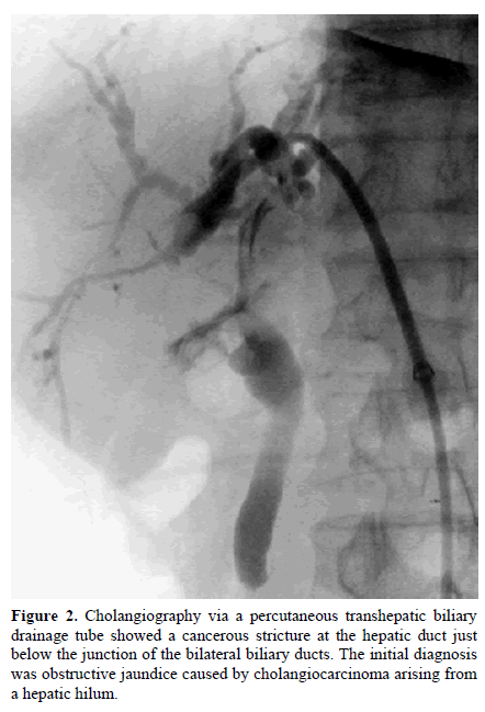 pancreas-cholangiography-transhepatic