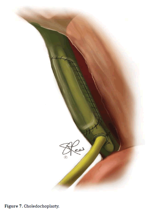 pancreas-choledochoplasty