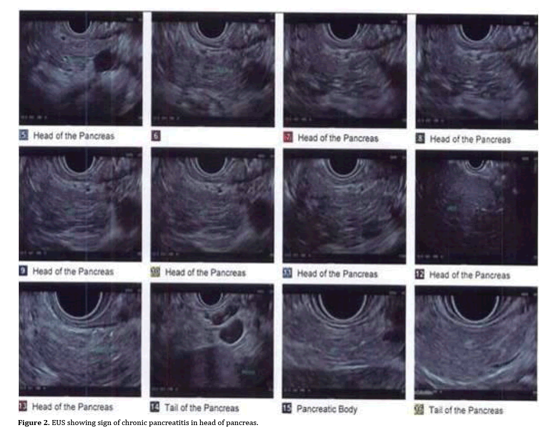 pancreas-chronic-pancreatitis