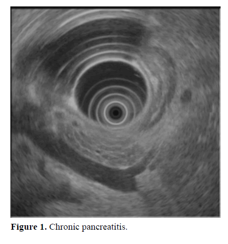 pancreas-chronic-pancreatitis