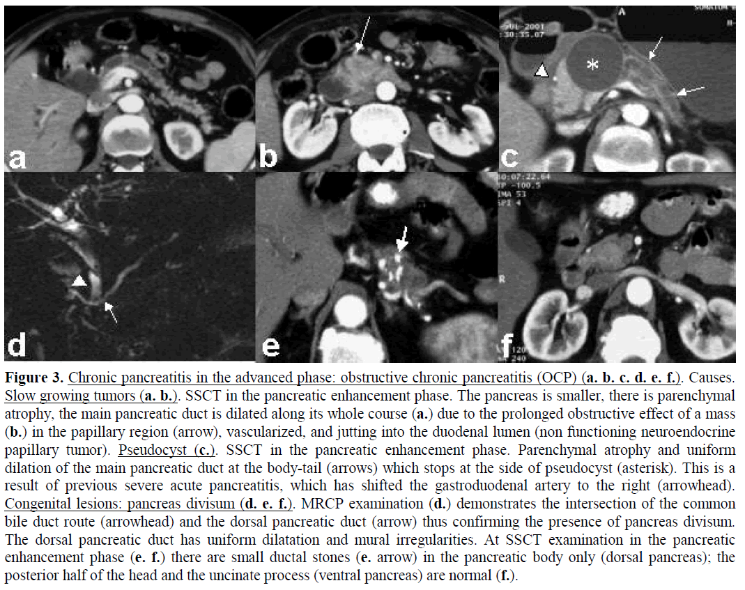 pancreas-chronic-pancreatitis-advanced