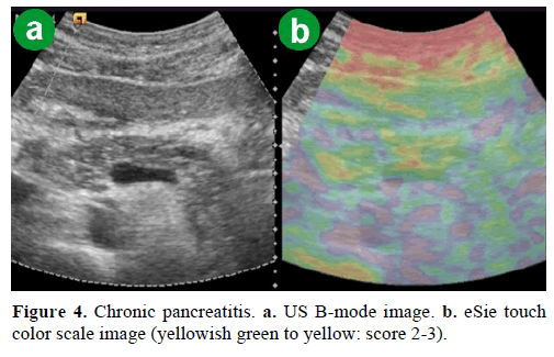 pancreas-chronic-pancreatitis-color-scale-image