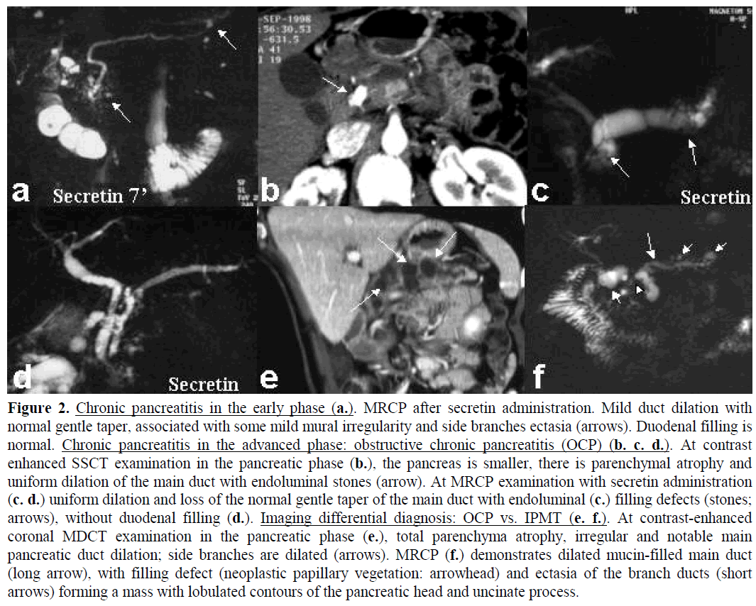 pancreas-chronic-pancreatitis-early