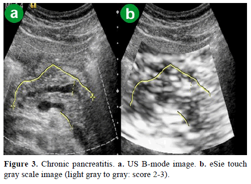 pancreas-chronic-pancreatitis-gray-scale-image