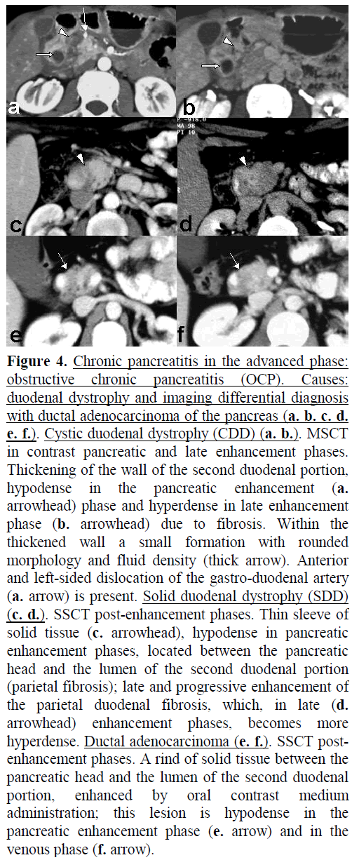 pancreas-chronic-pancreatitis-obstructive