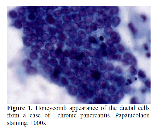 pancreas-chronic-pancreatitis-papanicolaou