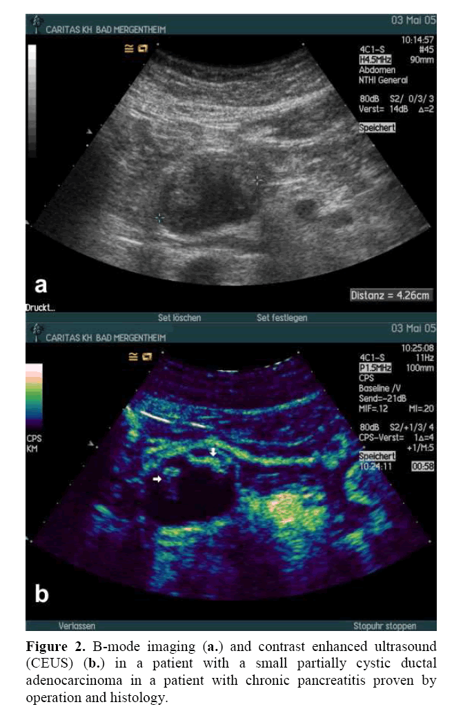 pancreas-chronic-pancreatitis-proven