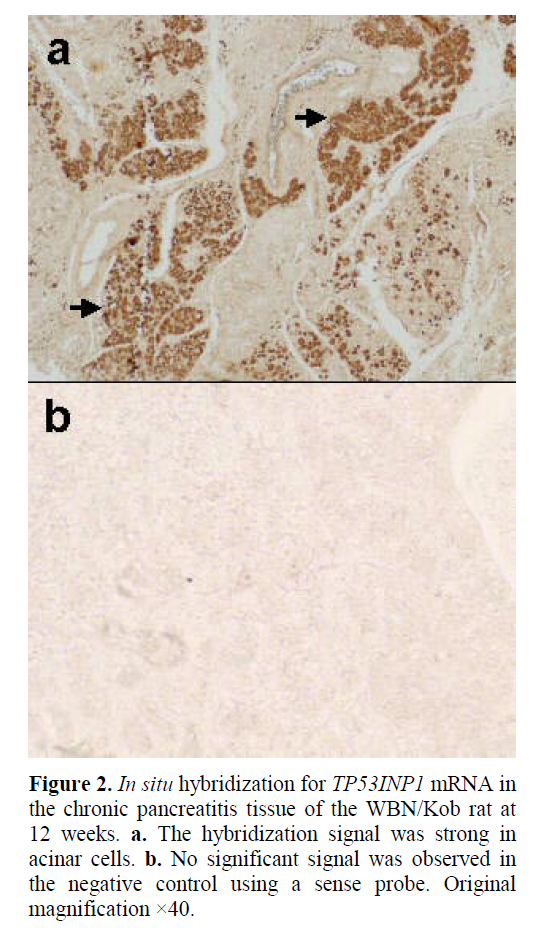 pancreas-chronic-pancreatitis-tissue