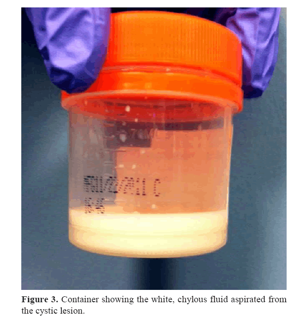 pancreas-chylous-fluid-aspirated