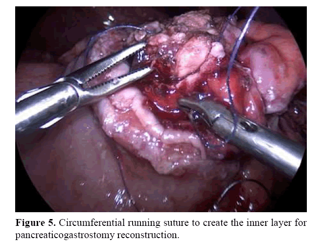 pancreas-circumferential-running-suture