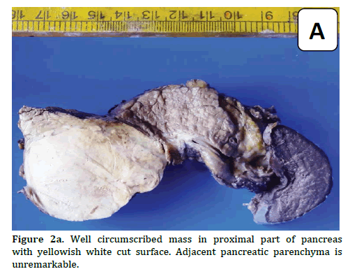 pancreas-circumscribed