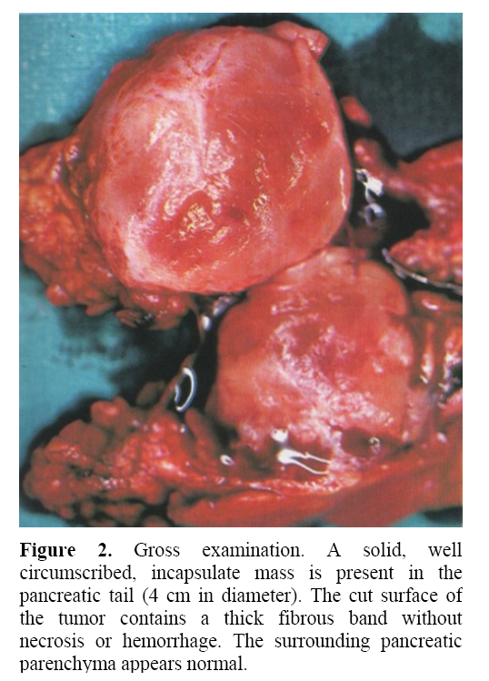 pancreas-circumscribed-incapsulate-mass