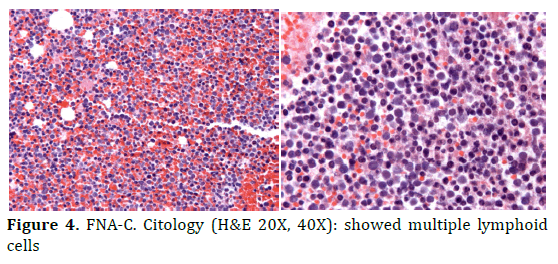 pancreas-citology-lymphoid-cells