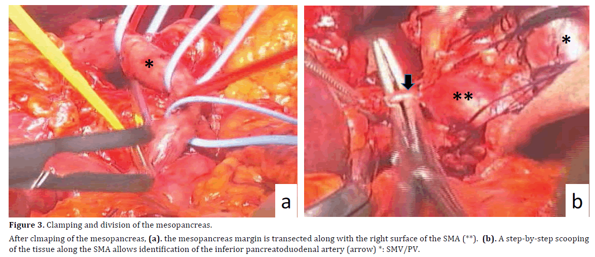 pancreas-clamping-division-mesopancreas