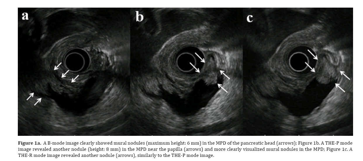 pancreas-clearly-showed-mural-nodules