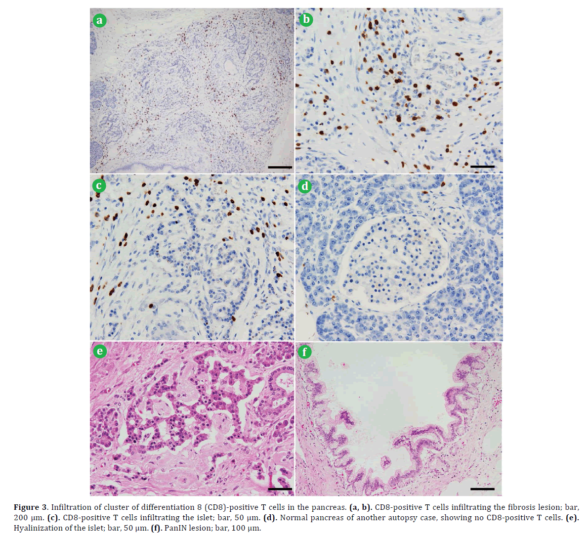 pancreas-cluster-fibrosis-lesion