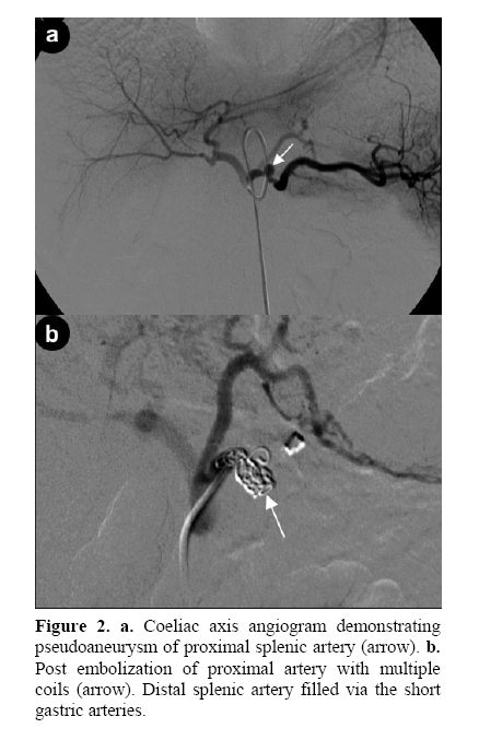 pancreas-coeliac-axis-angiogram