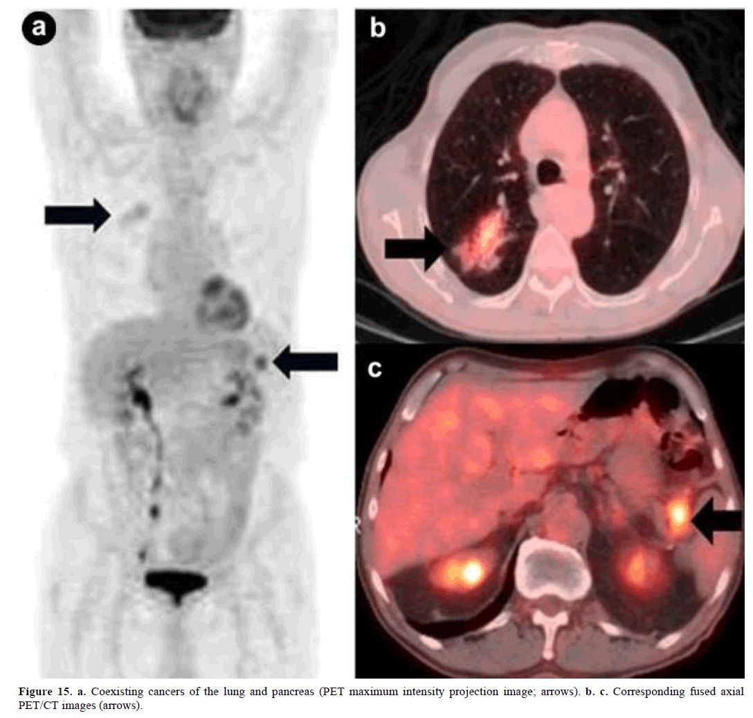 pancreas-coexisting-cancers-projection