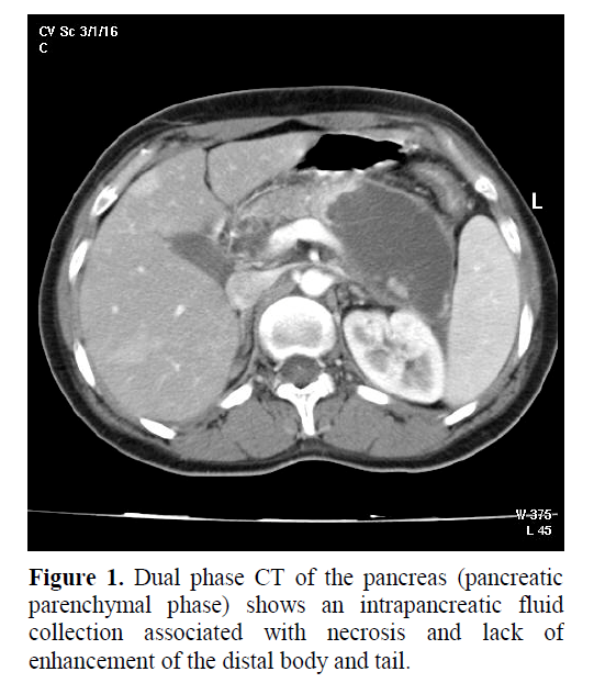 pancreas-collection-associated-necrosis