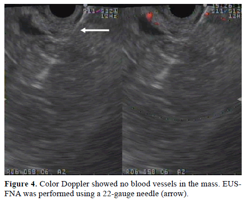 pancreas-color-doppler-blood-vessels