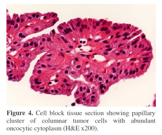 pancreas-columnar-tumor-cells