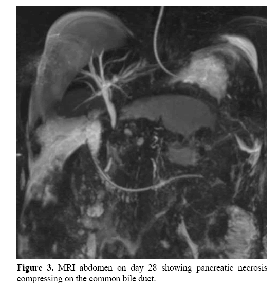 pancreas-common-bile-duct