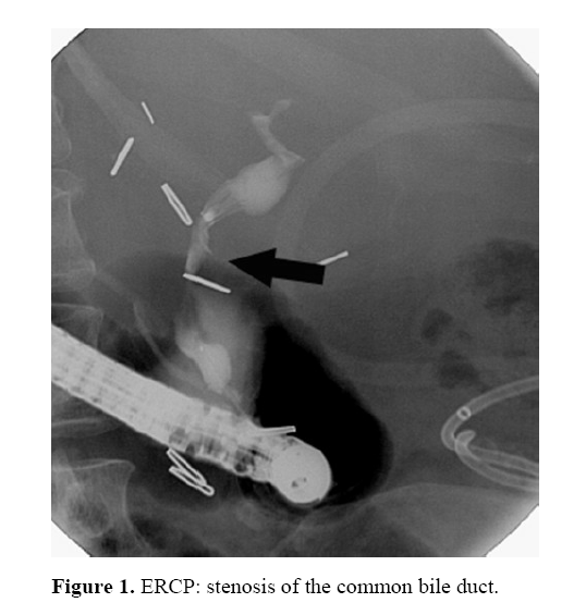 pancreas-common-bile-duct