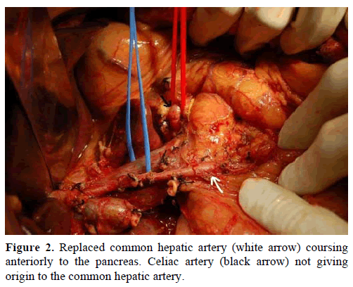 pancreas-common-hepatic-artery