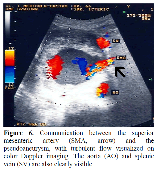 pancreas-communication-superior-mesenteric