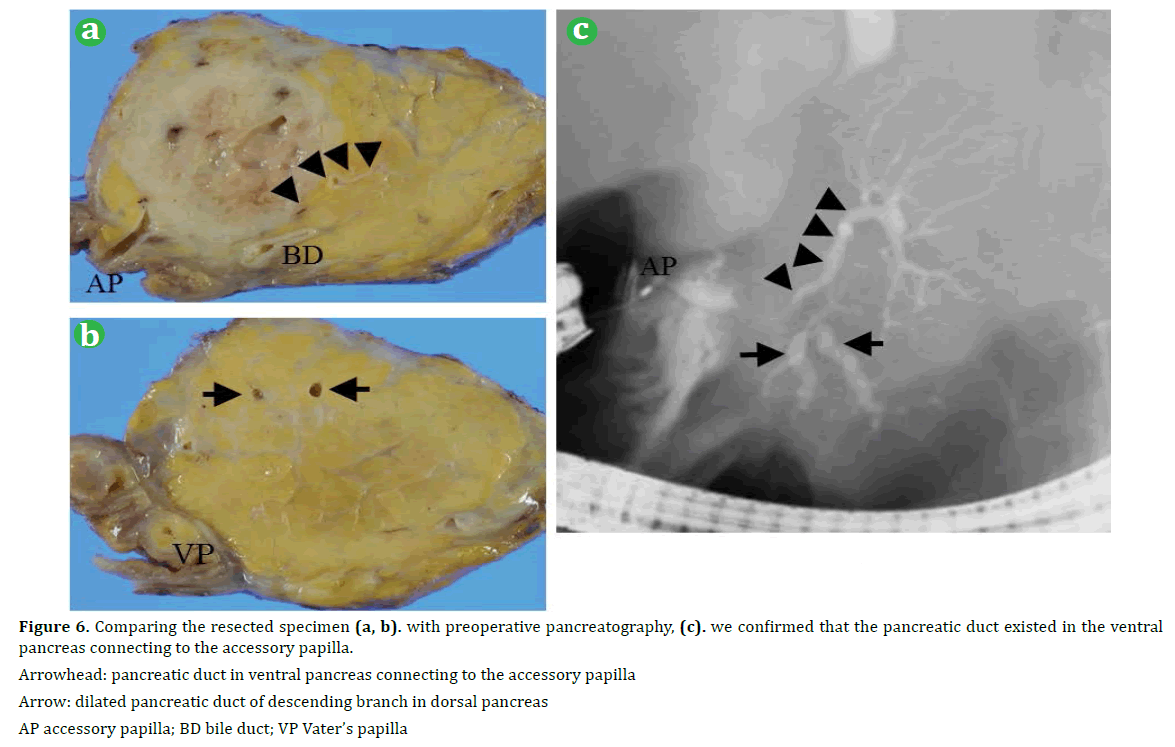 pancreas-comparing-resected