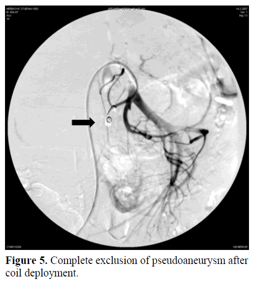 pancreas-complete-exclusion-pseudoaneurysm