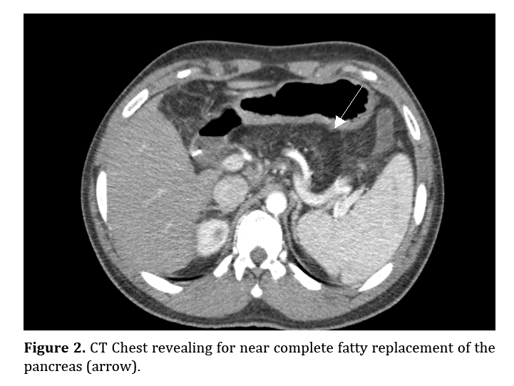 pancreas-complete-fatty-replacement