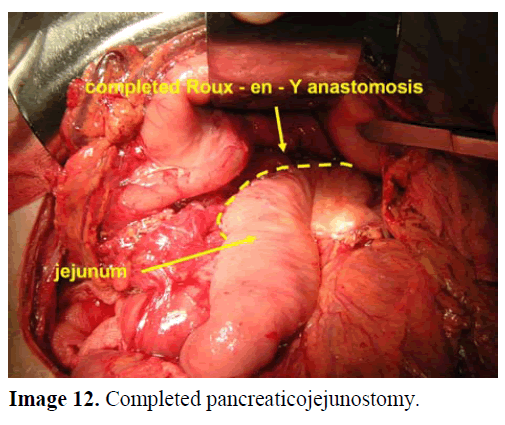 pancreas-completed-pancreaticojejunostomy