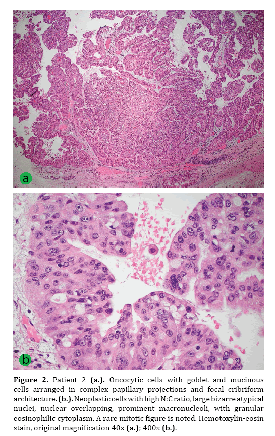 pancreas-complex-papillary-projections