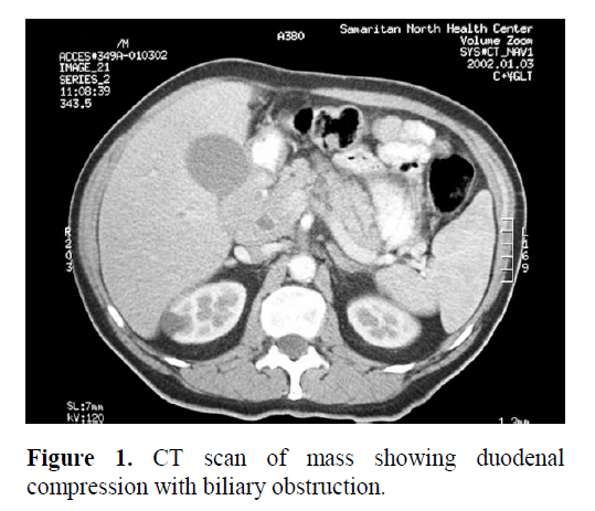 pancreas-compression-biliary-obstruction