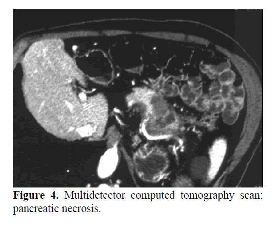 pancreas-computed-pancreatic-necrosis