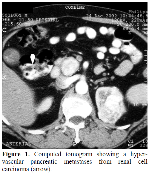 pancreas-computed-tomogram-hypervascular