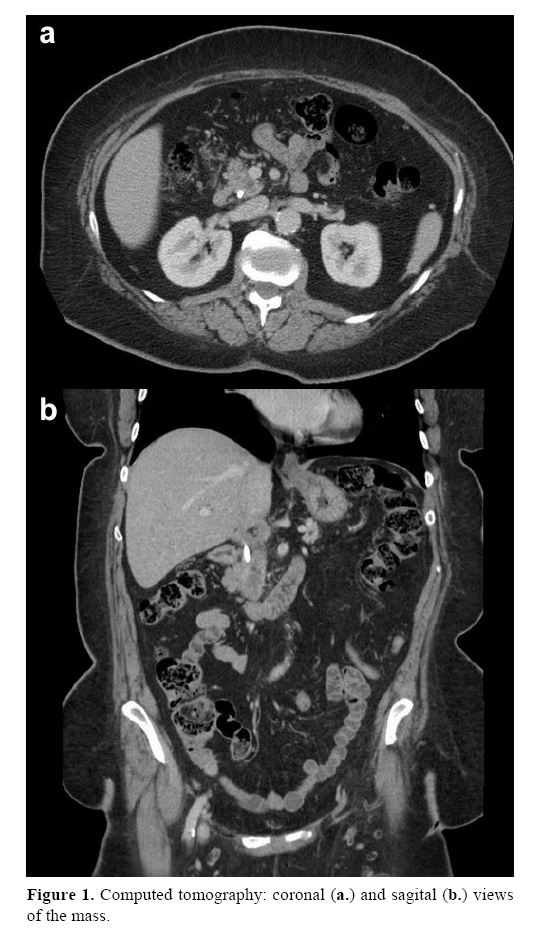 pancreas-computed-tomography